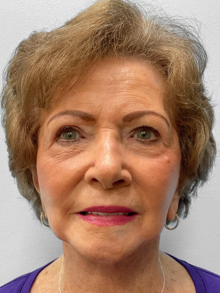 After Image: Facelift- Dr. Tucker - front