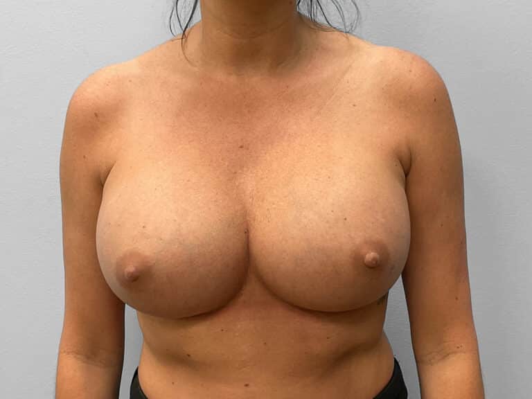 After Image: Breast Implant Exchange- Dr. Tucker - front