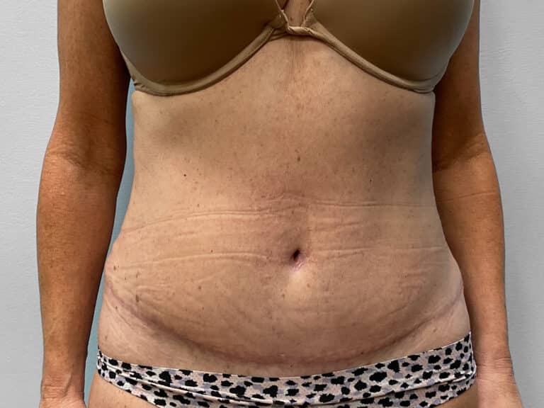 After Image: Abdominoplasty- Dr. Tucker - front