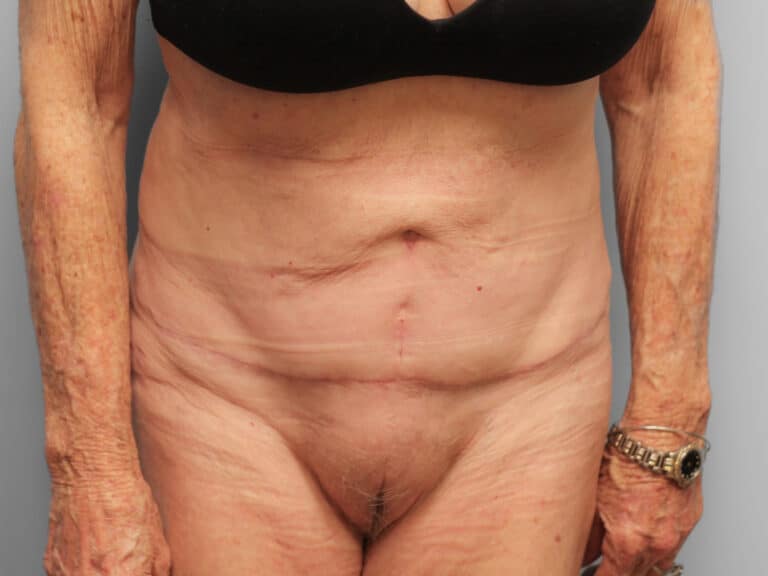 After Image: Tummy Tuck & Lipo- Dr. Tucker - front