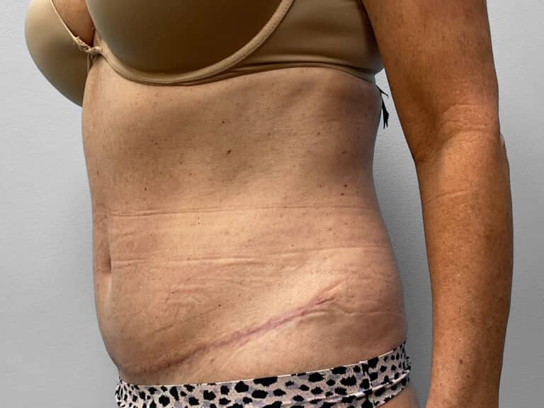 After Image: Abdominoplasty- Dr. Tucker - left-front-oblique
