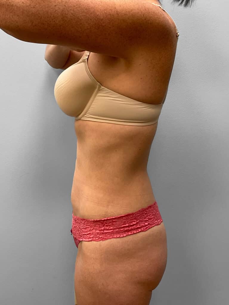 After Image: Liposuction- Dr. Howell - left-side
