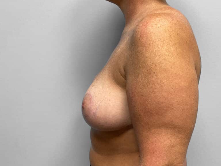 After Image: Breast Reduction & Lift- Dr. Howell - left-side