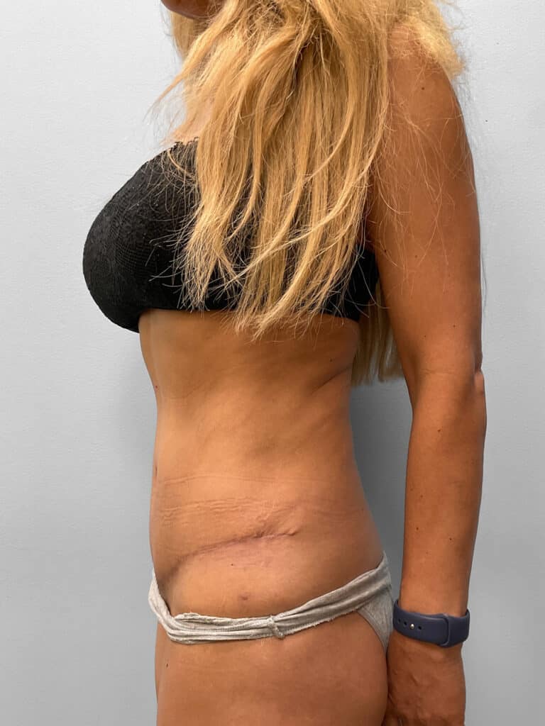 After Image: Tummy Tuck & Lipo- Dr. Howell - left-side