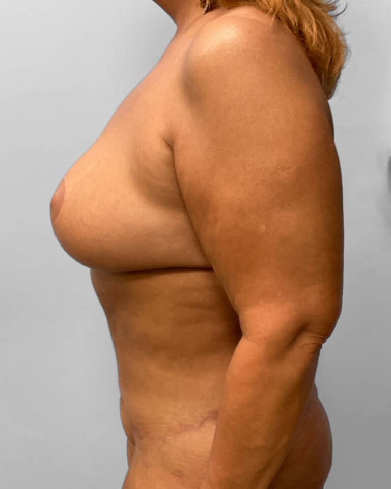 After Image: Mommy Makeover- Dr. Howell - left-side