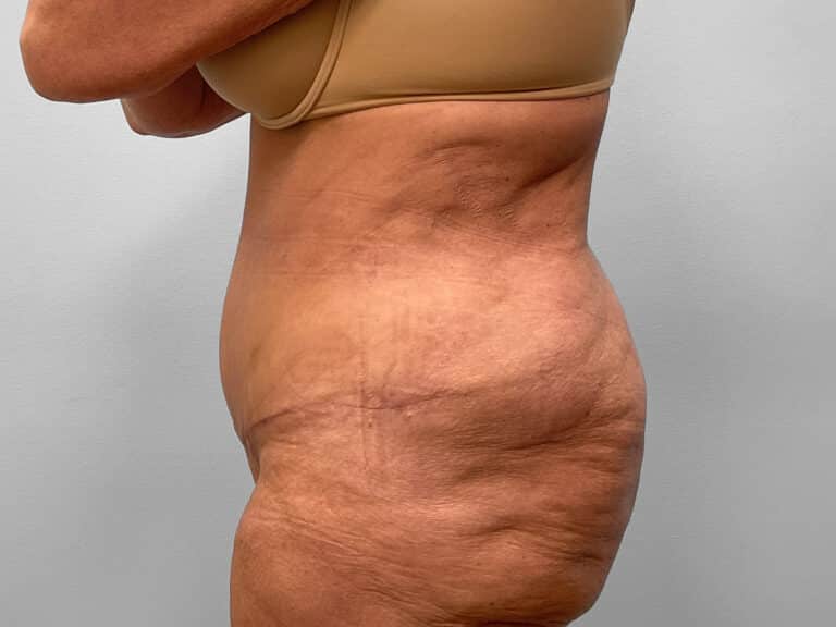 After Image: Abdominoplasty, Lipo & Thigh Lift- Dr. Tucker - left-side
