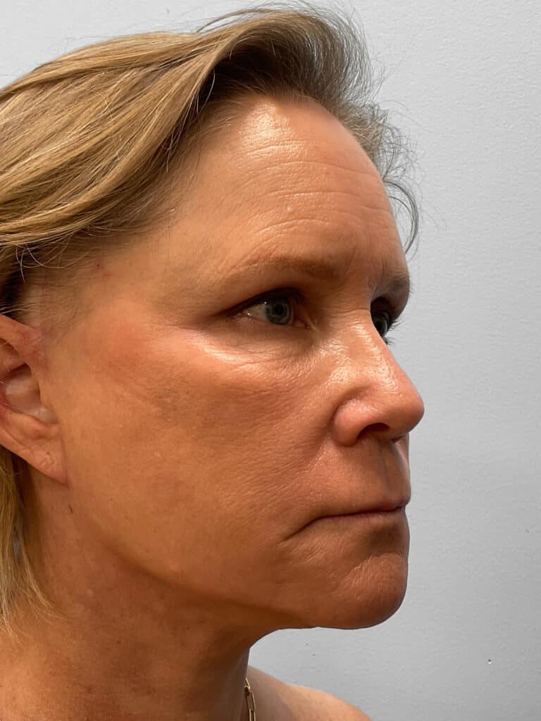 After Image: Facelift, Browlift, & Facial Rejuvenation- Dr. Howell - right-front-oblique