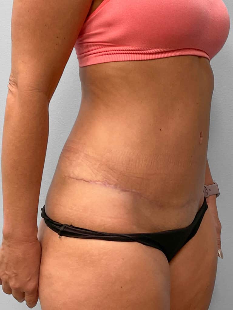 After Image: Tummy Tuck & Liposuction- Dr. Tucker - right-front-oblique