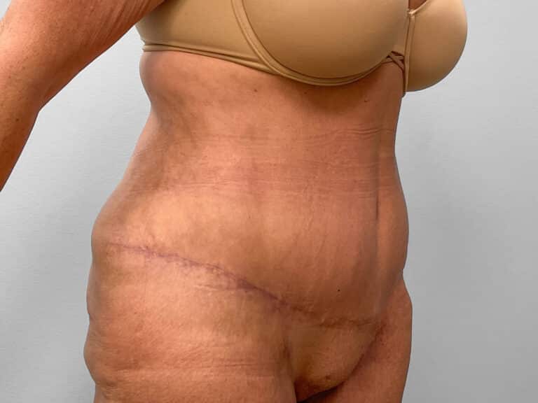After Image: Abdominoplasty, Lipo & Thigh Lift- Dr. Tucker - right-front-oblique