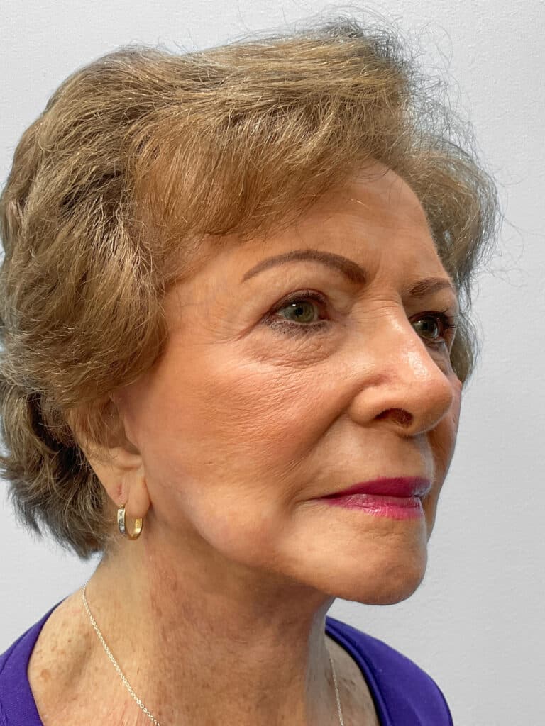 After Image: Facelift- Dr. Tucker - right-front-oblique