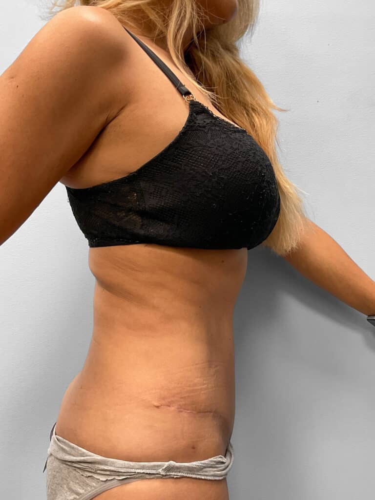After Image: Tummy Tuck & Lipo- Dr. Howell - right-side