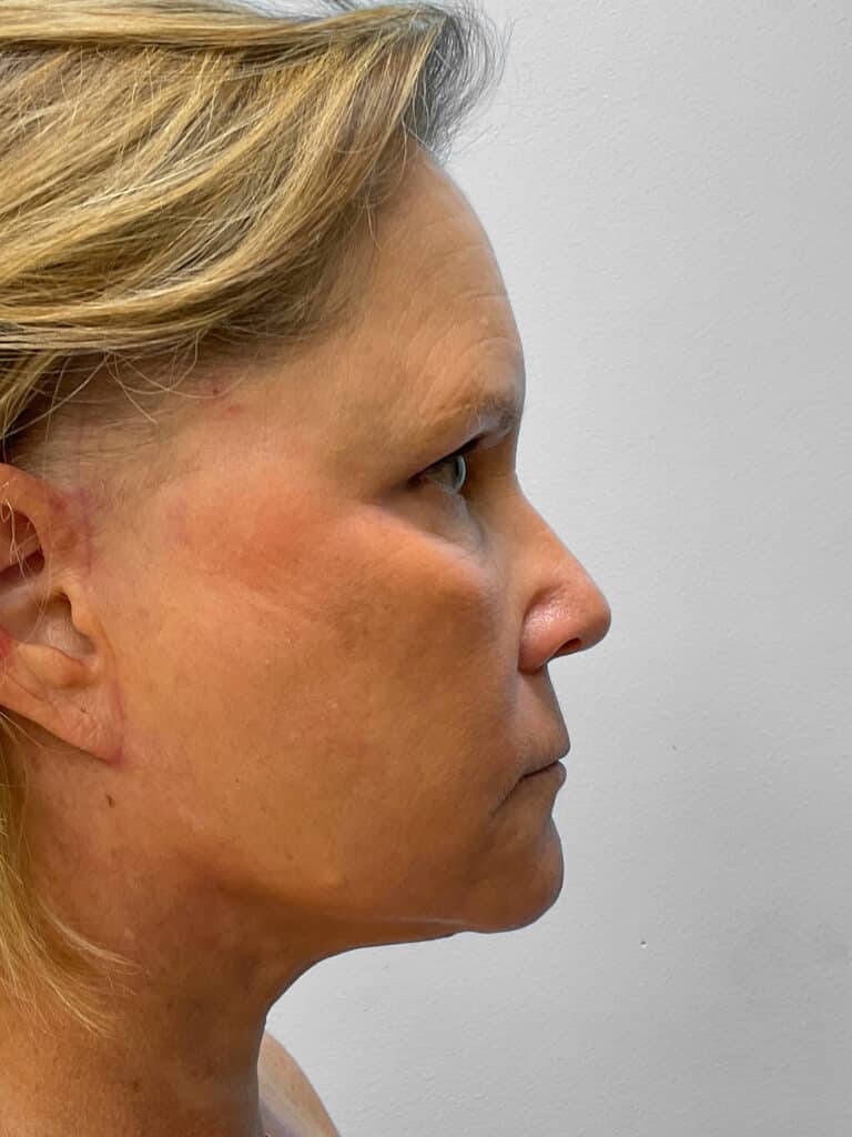 After Image: Facelift, Browlift, & Facial Rejuvenation- Dr. Howell - right-side