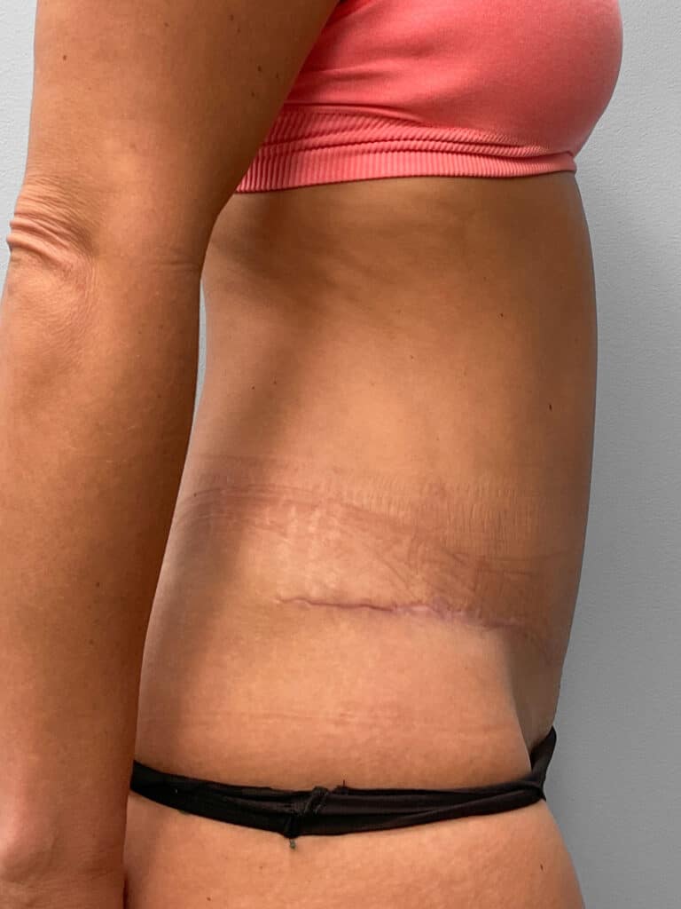 After Image: Tummy Tuck & Liposuction- Dr. Tucker - right-side