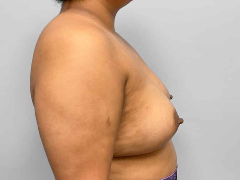 After Image: Breast Augmentation- Dr. Tucker - right-side