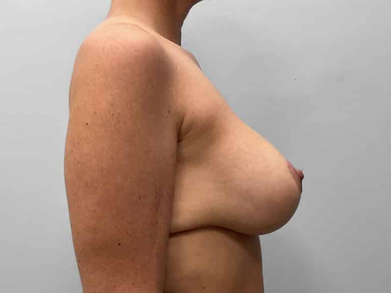 After Image: Breast Implant Exchange- Dr. Tucker - right-side