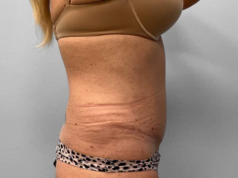 After Image: Abdominoplasty- Dr. Tucker - right-side