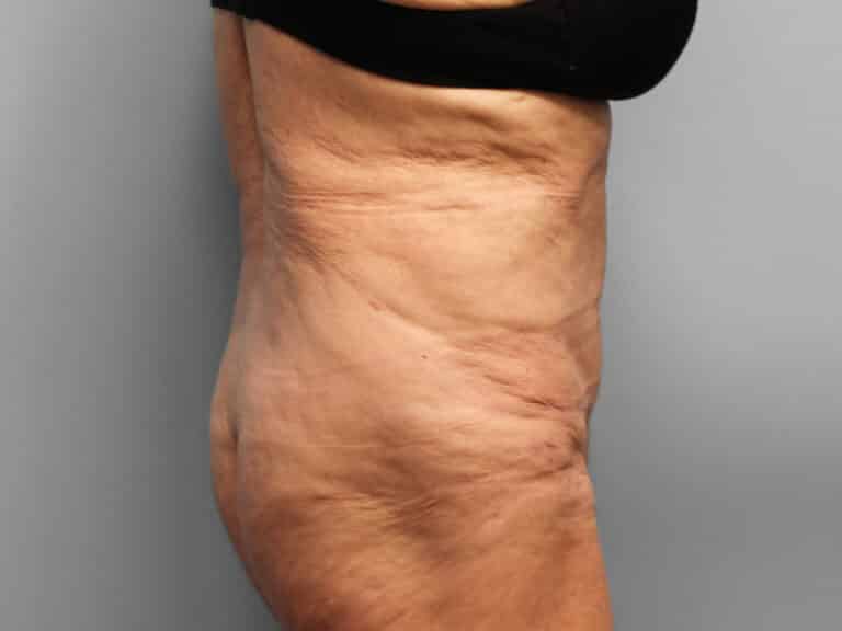 After Image: Tummy Tuck & Lipo- Dr. Tucker - right-side