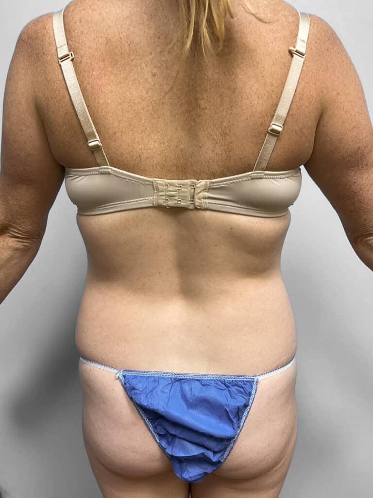 Before Image: Liposuction- Dr. Howell - back