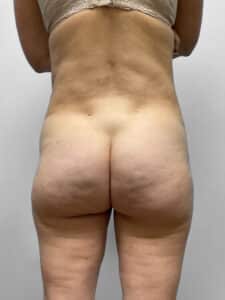 Before Image: BBL, Thigh Lift & Lipo- Dr. Tucker
