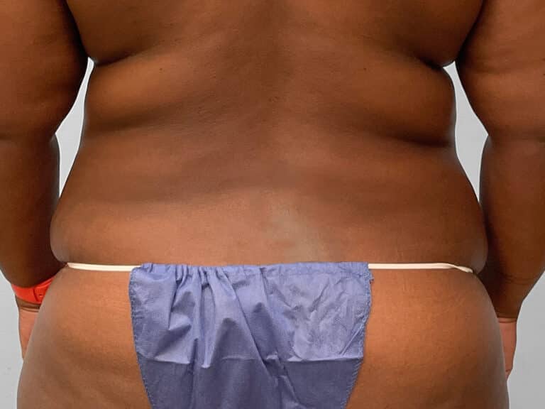 Before Image: Abdominoplasty & 360 Liposuction- Dr. Tucker - back