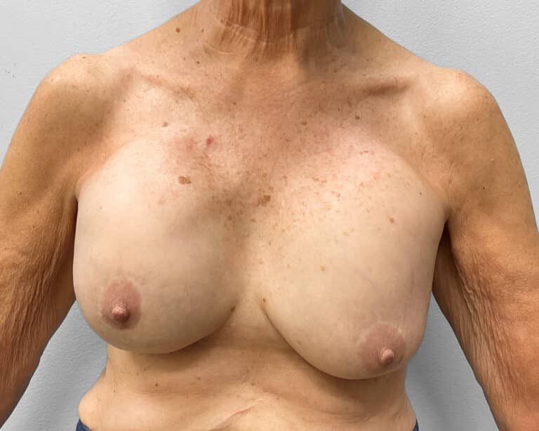 Before Image: Breast Lift & Implant Exchange- Dr. Howell - front