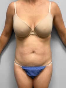 Before Image: Liposuction- Dr. Howell
