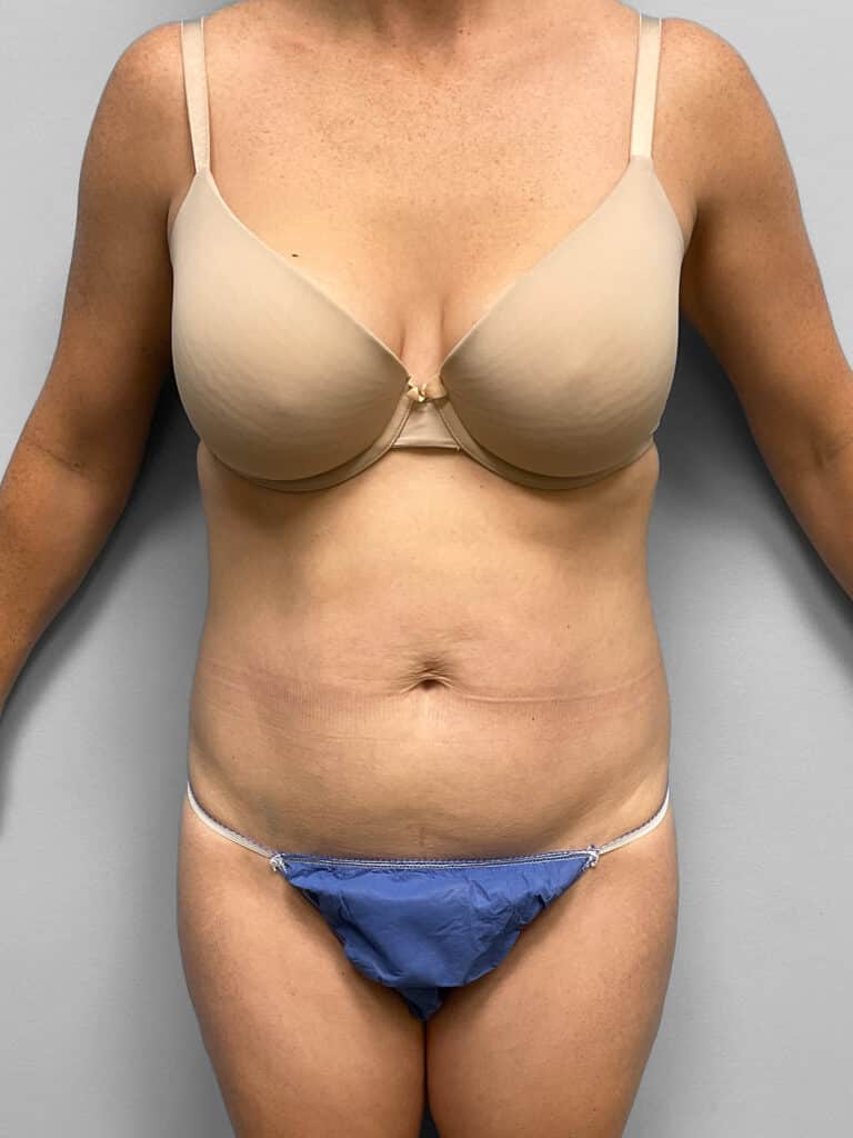 Before Image: Liposuction- Dr. Howell - front