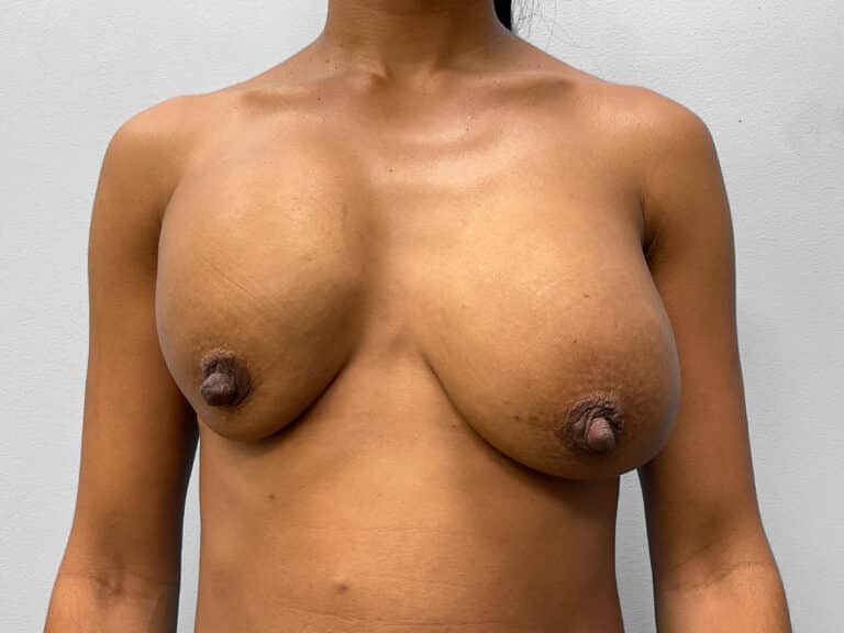 Before Image: Breast Implant Revision- Dr. Howell - front