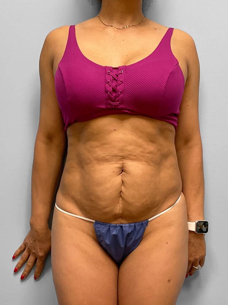 Before Image: Tummy Tuck & Lipo- Dr. Howell - front