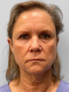 Before Image: Facelift, Browlift, & Facial Rejuvenation- Dr. Howell
