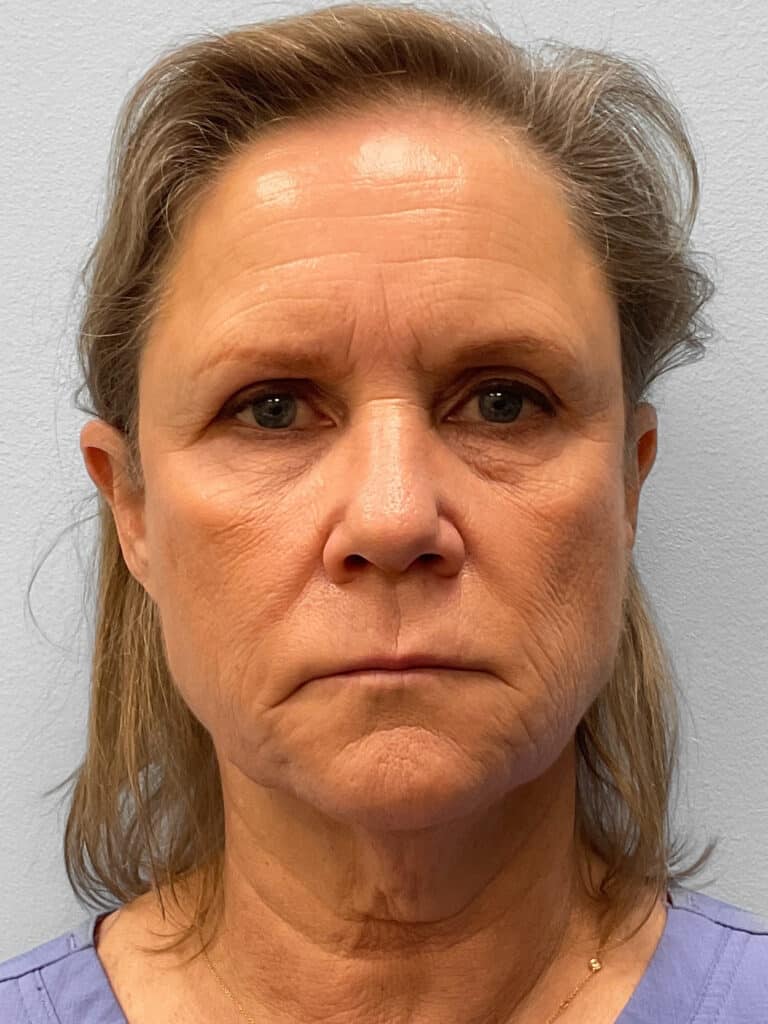 Before Image: Facelift, Browlift, & Facial Rejuvenation- Dr. Howell - front