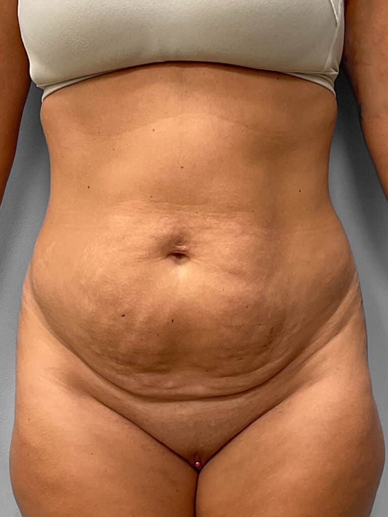Before Image: Tummy Tuck & Liposuction- Dr. Tucker - front