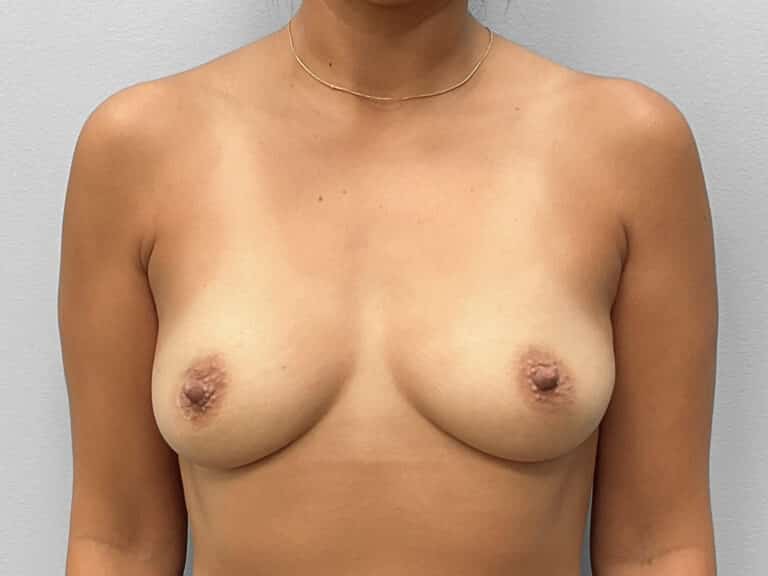 Before Image: Breast Augmentation- Dr. Tucker - front
