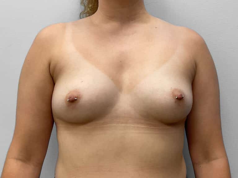 Before Image: Breast Augmentation- Dr. Tucker - front