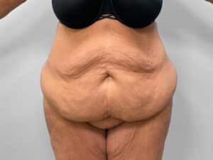 Before Image: Abdominoplasty, Lipo & Thigh Lift- Dr. Tucker