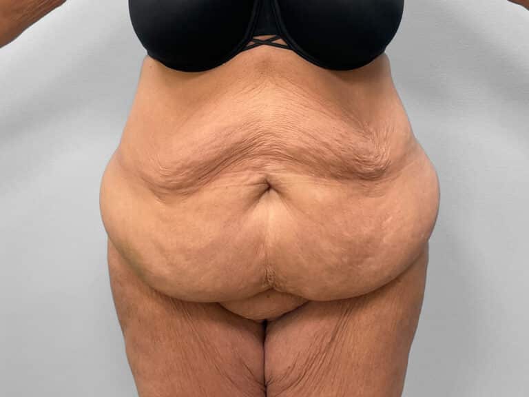 Before Image: Abdominoplasty, Lipo & Thigh Lift- Dr. Tucker - front