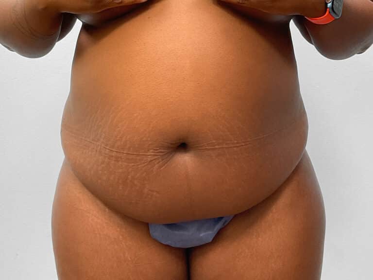 Before Image: Abdominoplasty & 360 Liposuction- Dr. Tucker - front