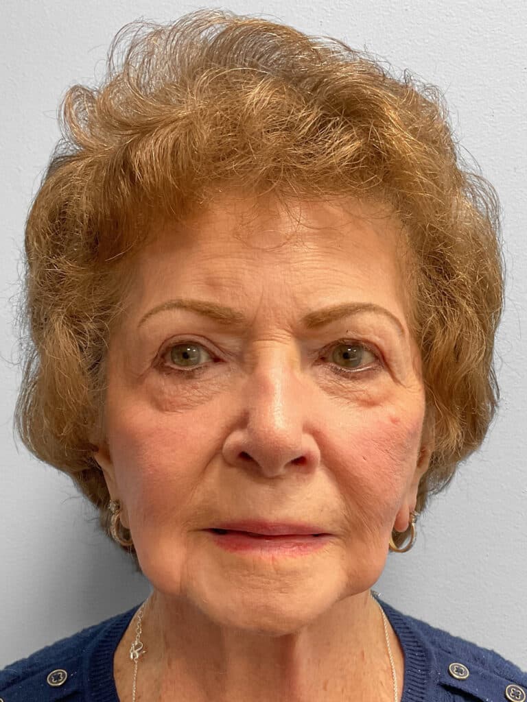 Before Image: Facelift- Dr. Tucker - front