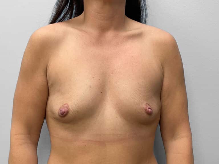 Before Image: Breast Augmentation- Dr. Tucker - front