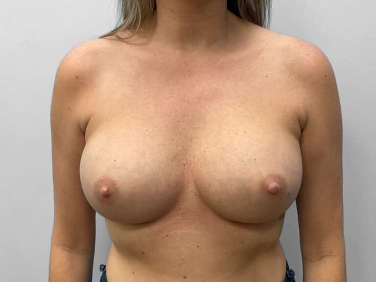 Before Image: Breast Implant Exchange- Dr. Tucker - front