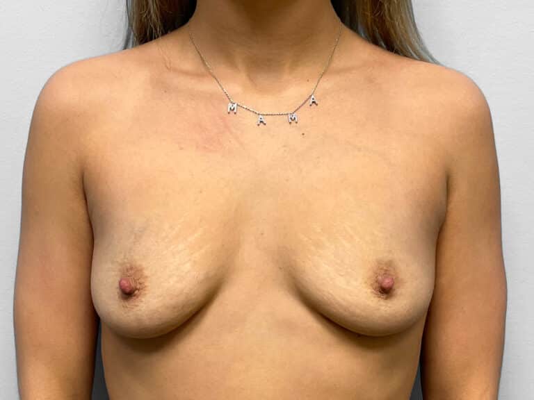 Before Image: Breast Augmentation with Lift- Dr. Tucker - front