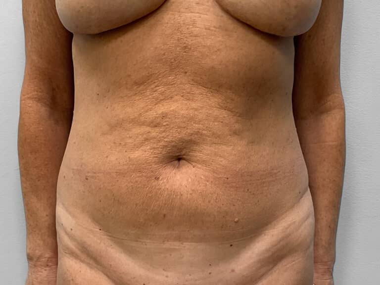 Before Image: Abdominoplasty- Dr. Tucker - front