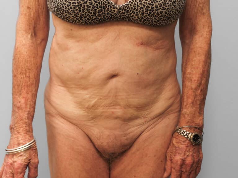 Before Image: Tummy Tuck & Lipo- Dr. Tucker - front