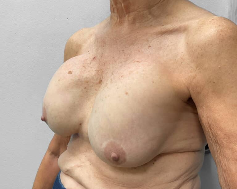 Before Image: Breast Lift & Implant Exchange- Dr. Howell - left-front-oblique