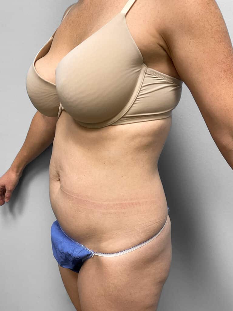 Before Image: Liposuction- Dr. Howell - left-front-oblique