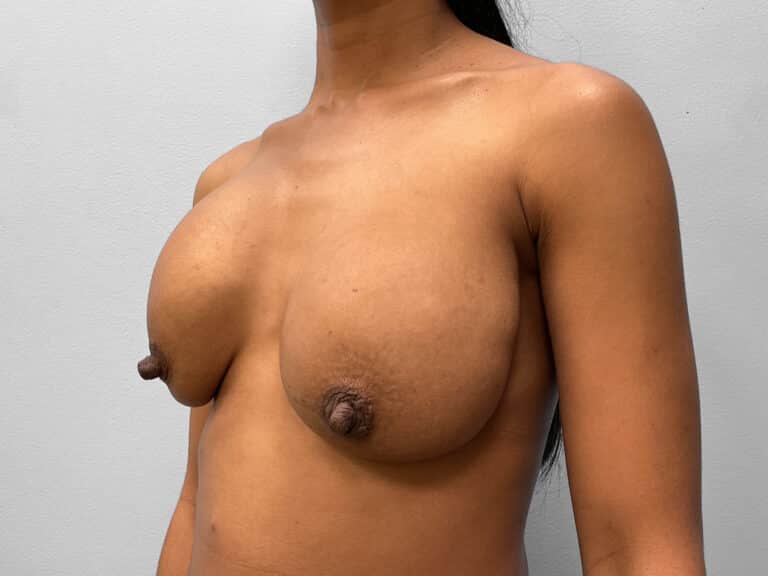 Before Image: Breast Implant Revision- Dr. Howell - left-front-oblique