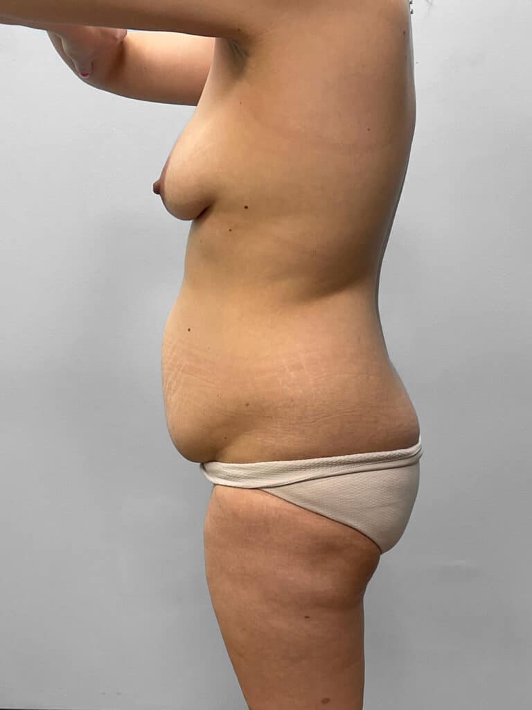 Before Image: Mommy Makeover- Dr. Howell - left-side