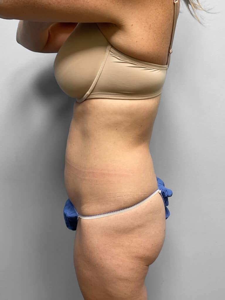 Before Image: Liposuction- Dr. Howell - left-side