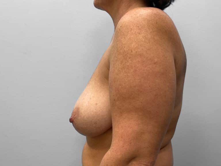 Before Image: Breast Reduction & Lift- Dr. Howell - left-side