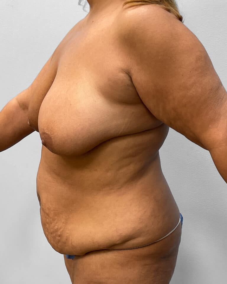 Before Image: Mommy Makeover- Dr. Howell - left-front-oblique